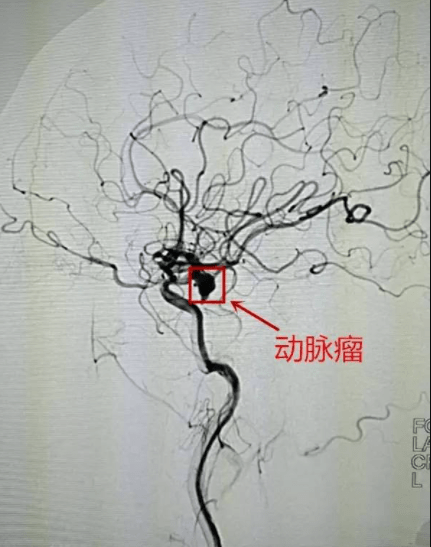 脑血管造影,你了解吗?_检查_病变_包括