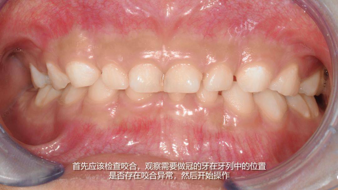 以3m产品为例乳牙金属预成冠步骤034.对金属冠过敏(镍,铬)3.