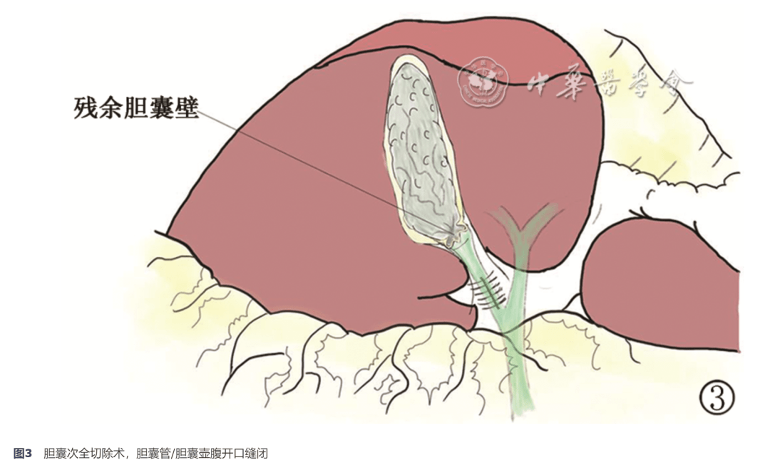 困難性腹腔鏡膽囊切除術的手術技巧和策略選擇_解剖_膽管_間隙