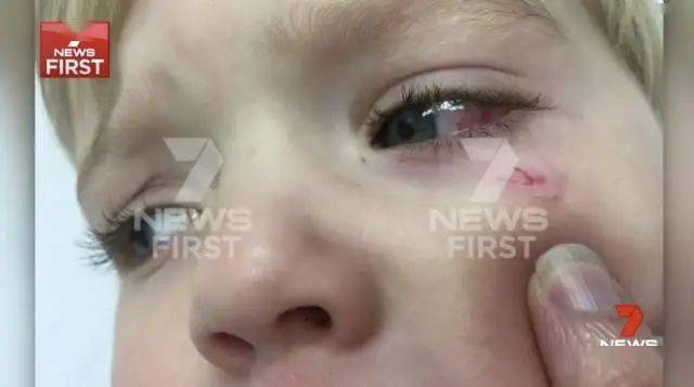 被严重啄伤,眼睛虹膜被撕裂且晶状体被刺穿;类似的事件也不止这一起