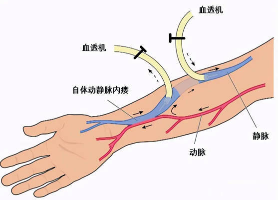 血液透析管路密封性及魯爾圓錐接頭測試儀_靜脈_壓力_動脈