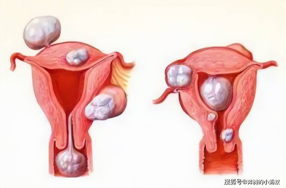 慢性宫颈炎分泌物图片