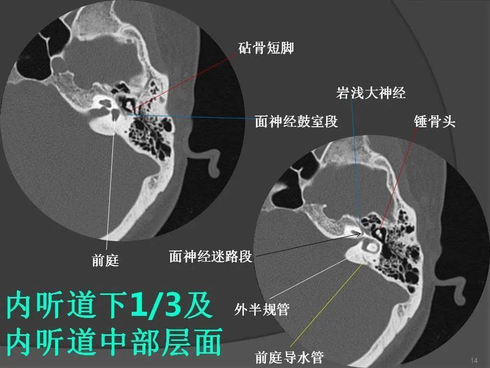 顳骨斷層解剖及ct三維重建(推薦收藏)_綜合徵_氣管_平臺