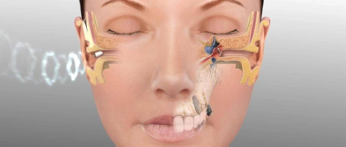 这一过程中,声波会经过耳膜并造成一定的伤害,而骨传导耳机的因为是