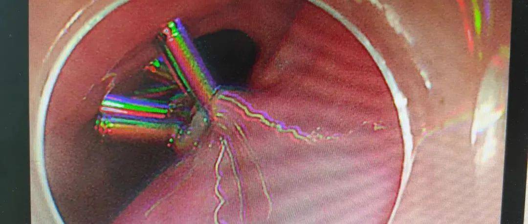 高难度高要求|西安市第三医院消化内科持续开展POEM术解决患者病痛_食管_手术_治疗