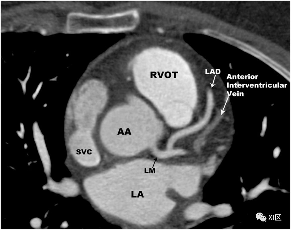 心脏CT横断面解剖图图片