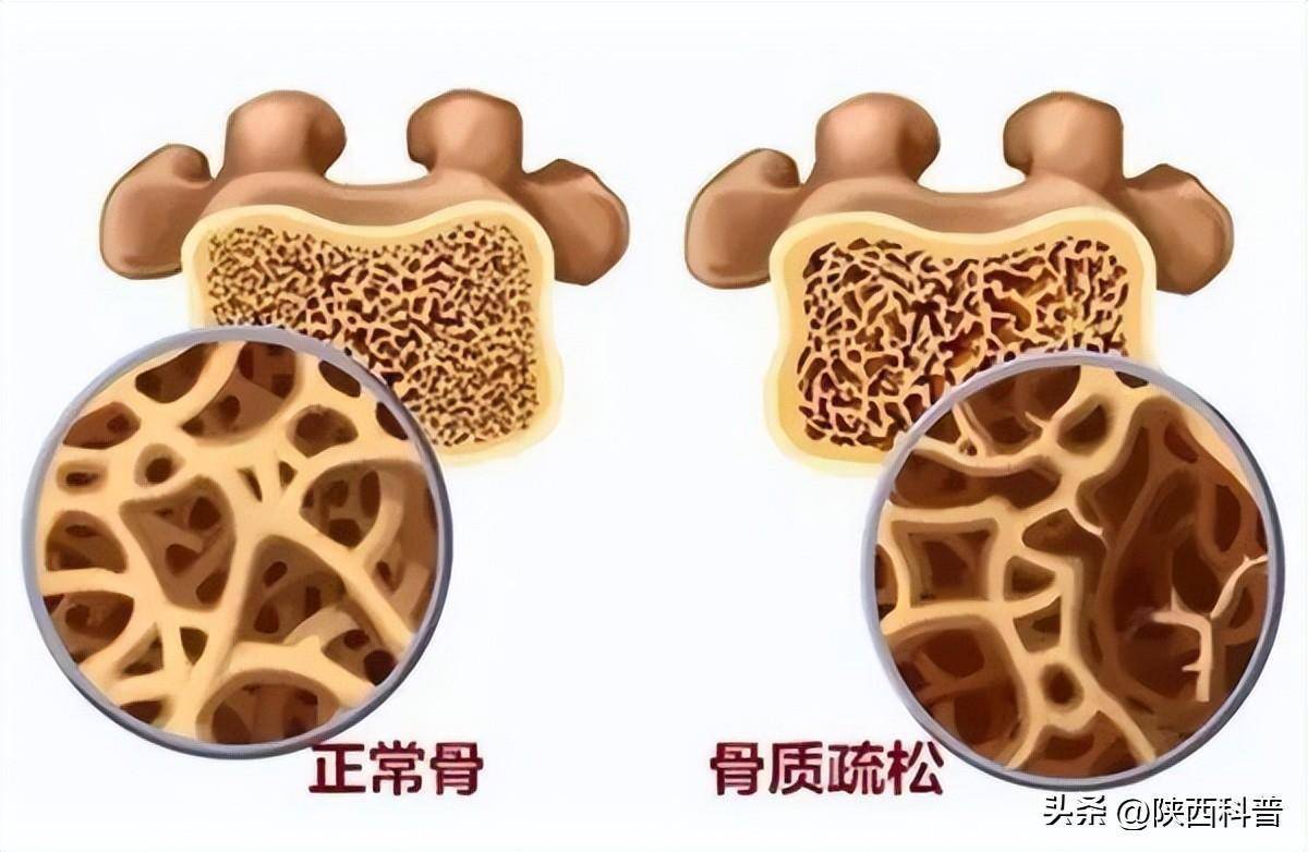 如何缓解这种情况?_老年人_骨质疏松症_网络