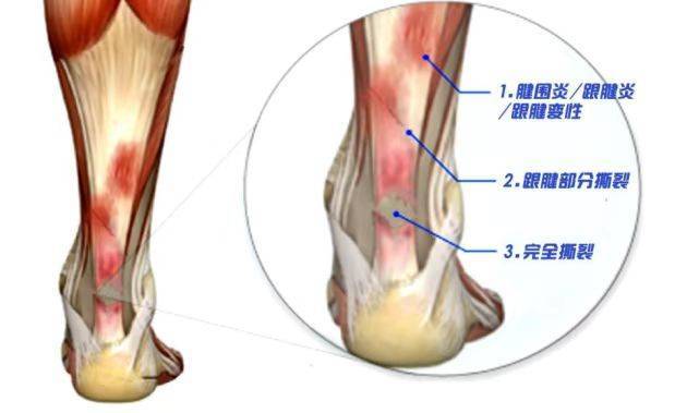 跟腱怎么变长图片