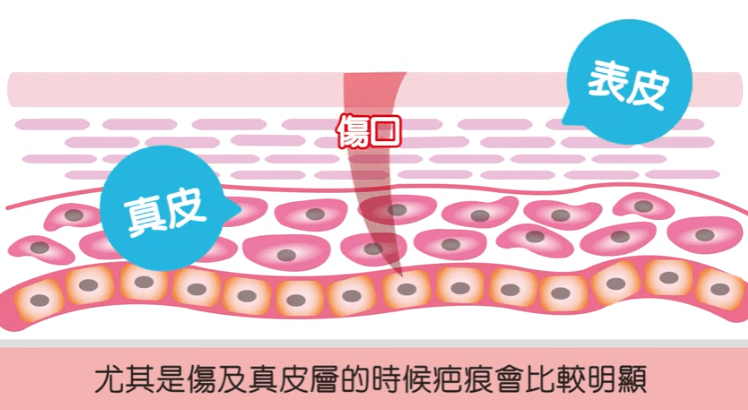 伤口_进行_影响