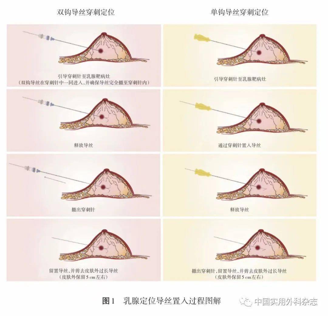 指南與共識|中國可視化經皮穿刺乳腺組織定位導絲與定位標記夾臨床