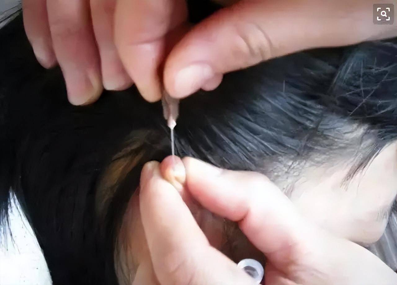 终生致力于"王氏刺血疗法",治愈患者不计其数_治疗_王峥_先生