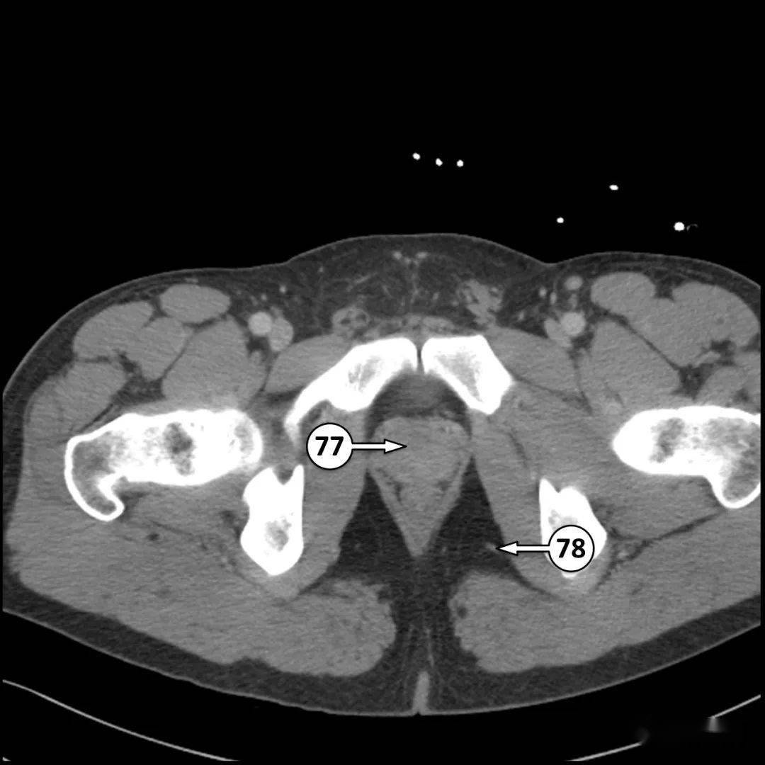 77 前列腺78 直肠下动脉79 精索80 坐骨肛门窝81 右股总静脉82