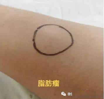 2,脂肪瘤:由于脂肪异常分化导致,大部分并无症状,少数脂肪瘤压迫神经