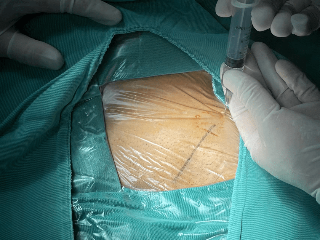 科普| 局麻下能做好"疝气"手术吗? 能!_患者_全麻_麻醉