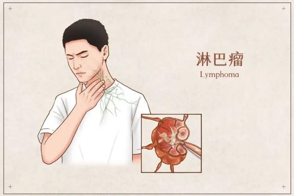 伴有发热,盗汗,消瘦,瘙痒等全身症状,根据瘤细胞分为非霍奇金淋巴瘤和