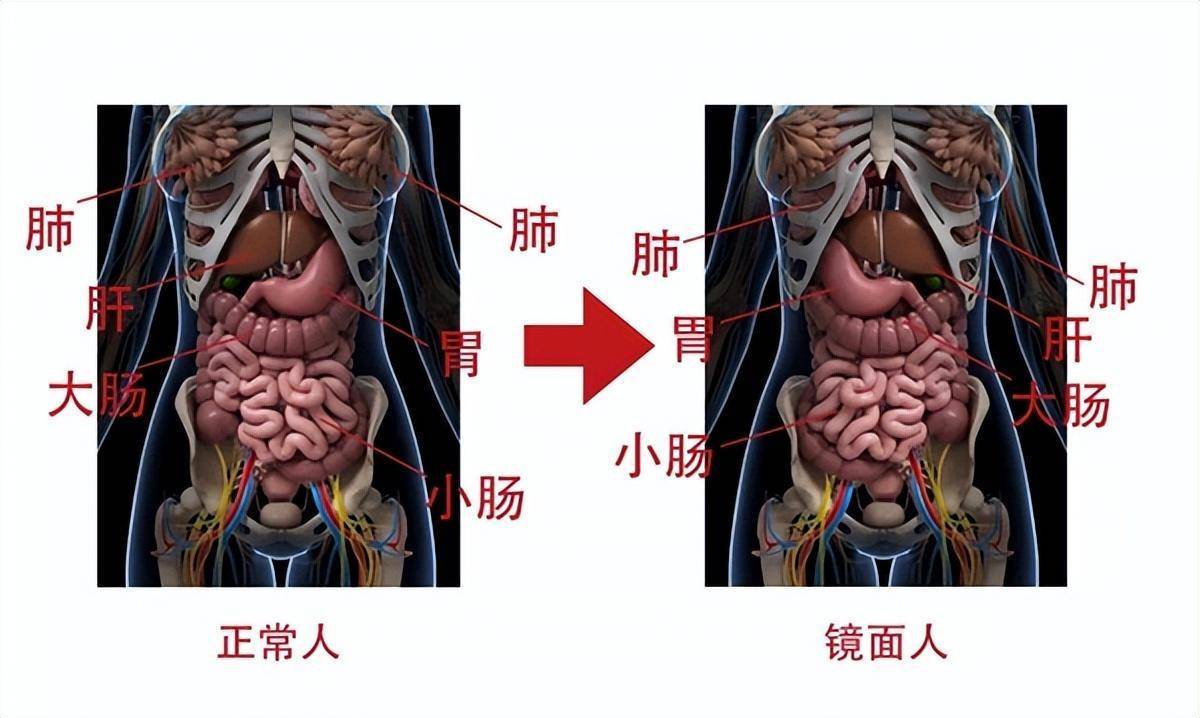 一女子五脏六腑全部反着长 器官反着长有什么影响？