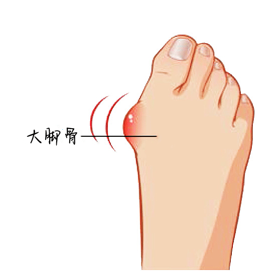 北京丰台广济医院科普:脚大拇指旁边骨头突出是什么原因?