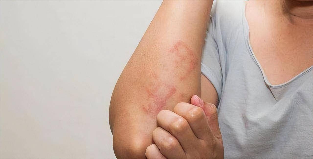 服用甲钴胺后会出现过敏反应,比如出现皮疹皮肤瘙痒等现象,甲钴胺的副