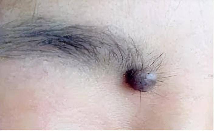 abcde法自测危险程度_直径_皮内痣_mm