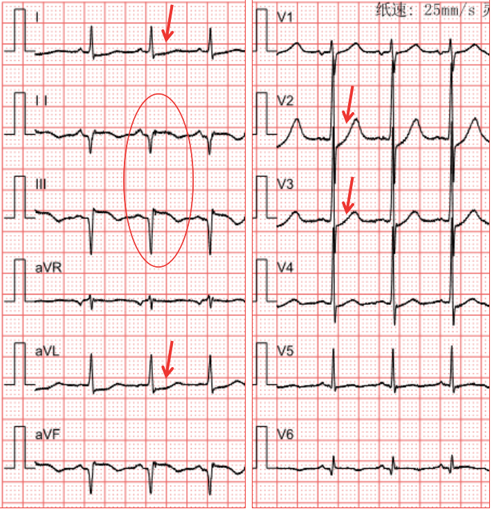 st抬高典型心电图图片