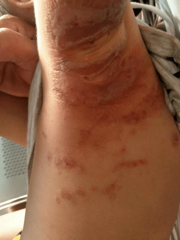 可治愈接触性皮炎_治疗_皮肤_患处