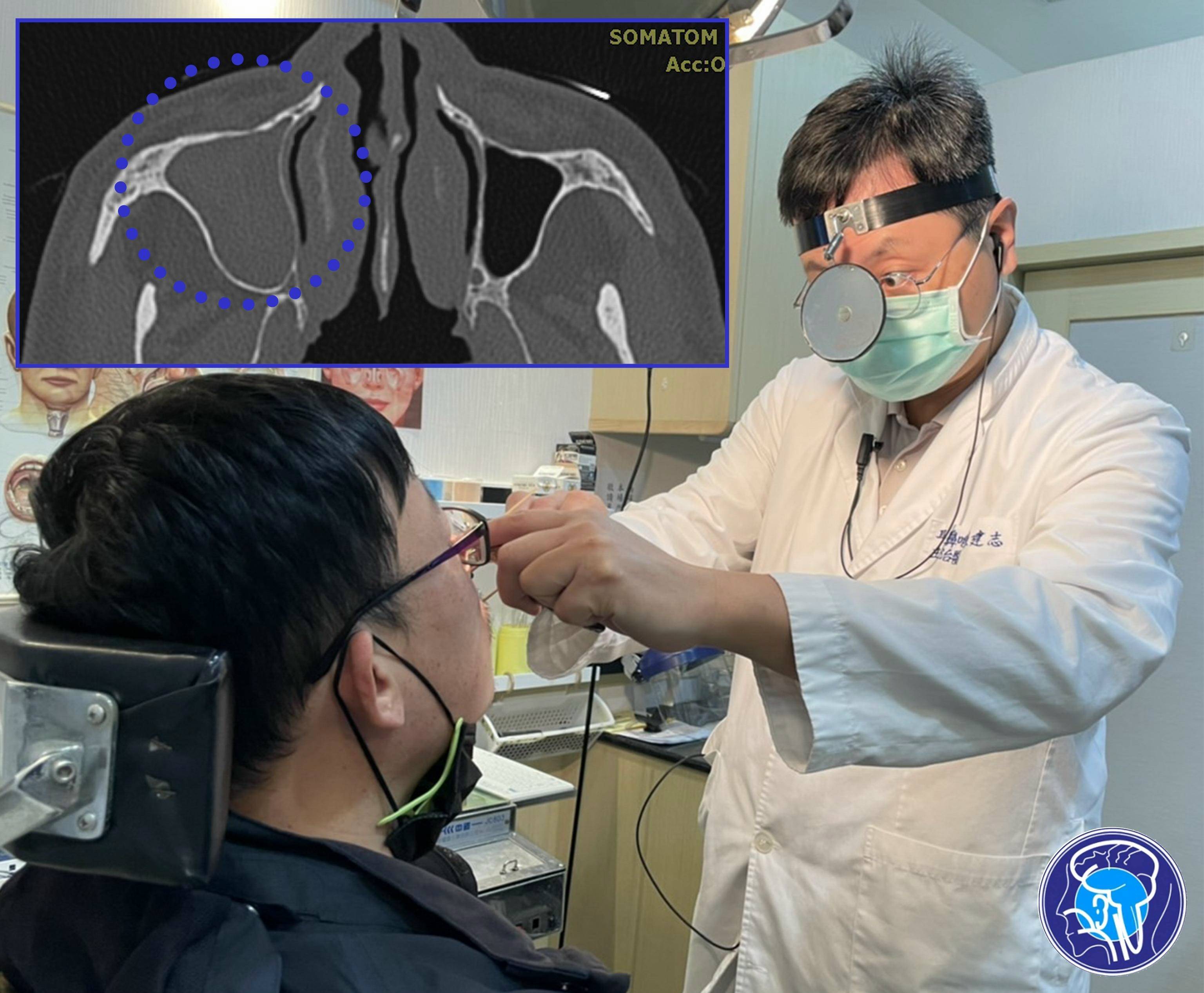 男子慢性眩暈就醫 源頭竟在鼻竇_上頜_前庭_嚴重