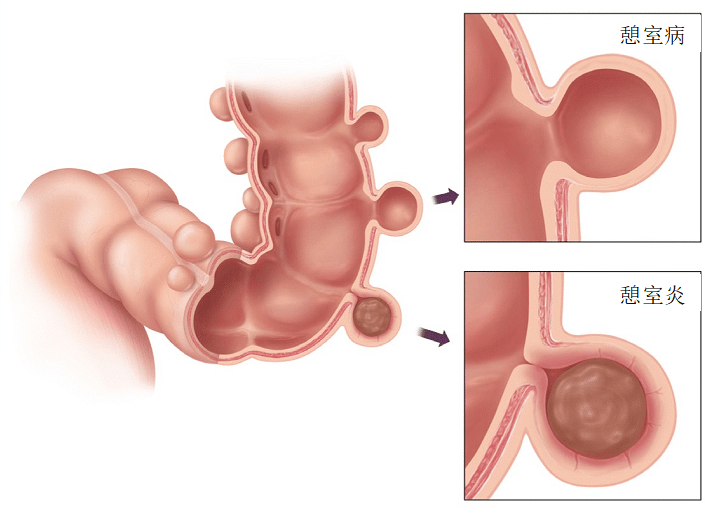 来自查:憩室病,结肠最常见的非癌性病变_患者_治疗_肠壁