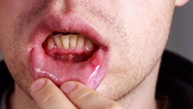 口舌生疮最快治疗方法图片