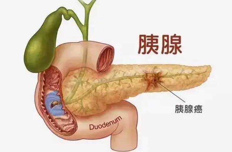 1,胰腺癌胰腺癌是所有器官癌变中,恶性程度最高的一个类型,它的病发率