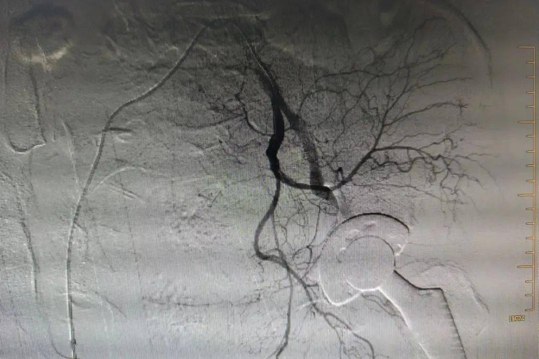 髂内动脉造影图谱图片