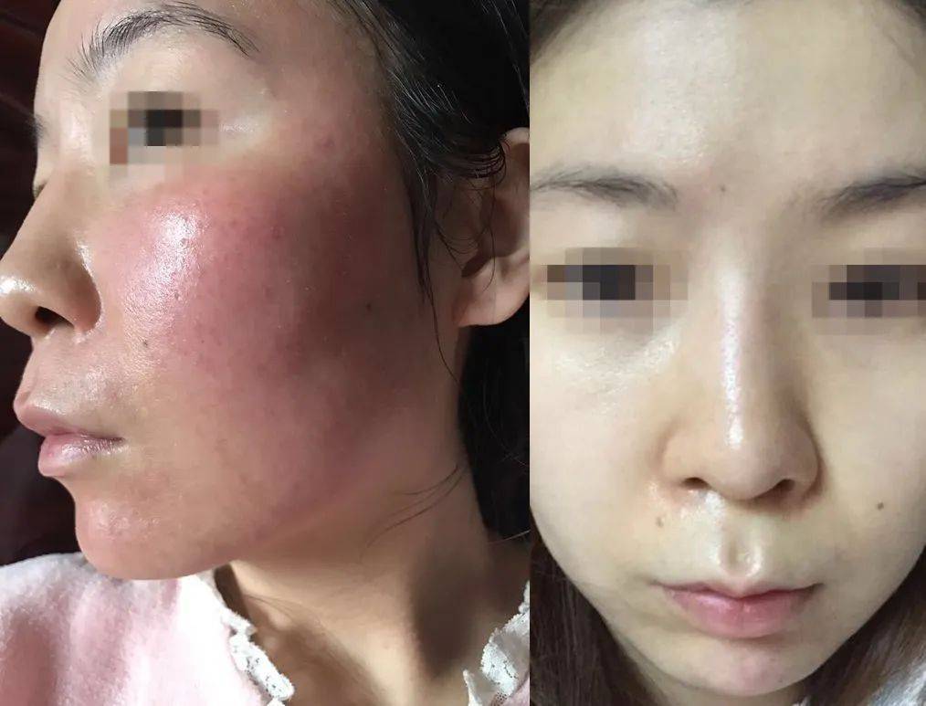 激素脸能用甘油兑水敷脸吗?_皮肤_皮炎_症状