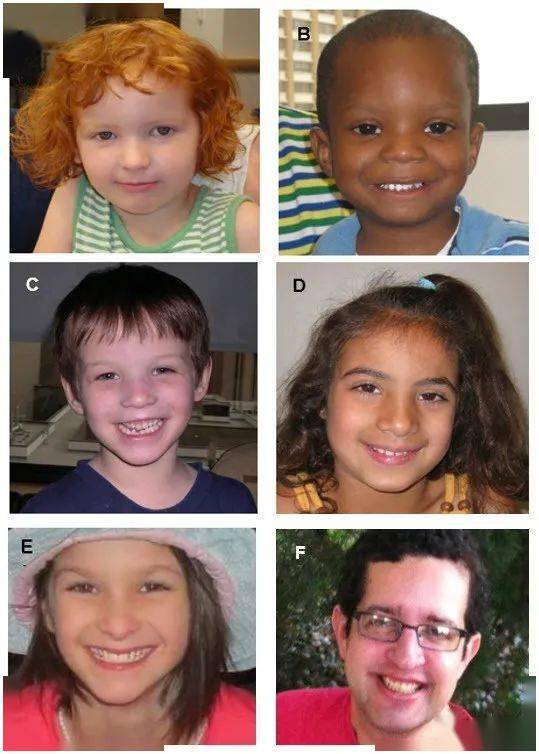 基因突变的孩子图片图片