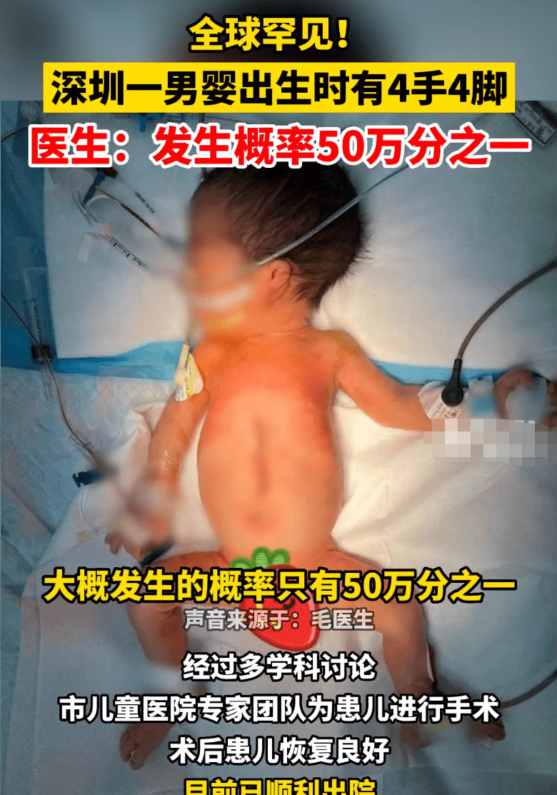 全球罕见！男婴出生时＂4手4脚＂,医生：寄生胎,网友：没产检吧