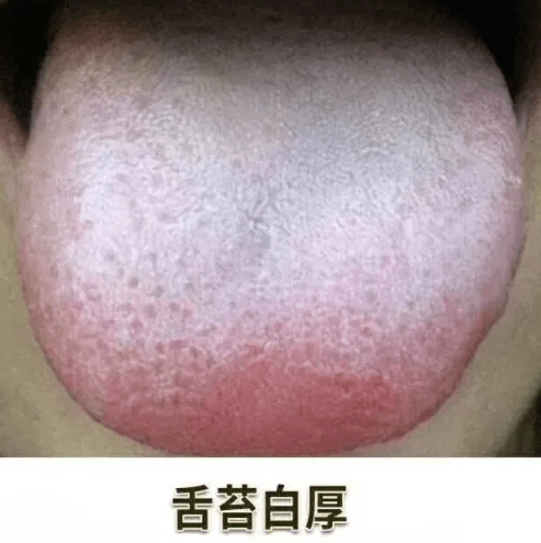 脾胃虚寒的人,舌头表面舌苔是又白又厚的,看起来也是湿润的,舌头边缘