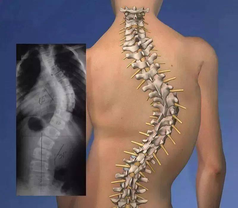 脊柱侧弯导致脊柱变形,肩背部不平,胸廓畸形,骨盆倾斜,长短腿,姿势
