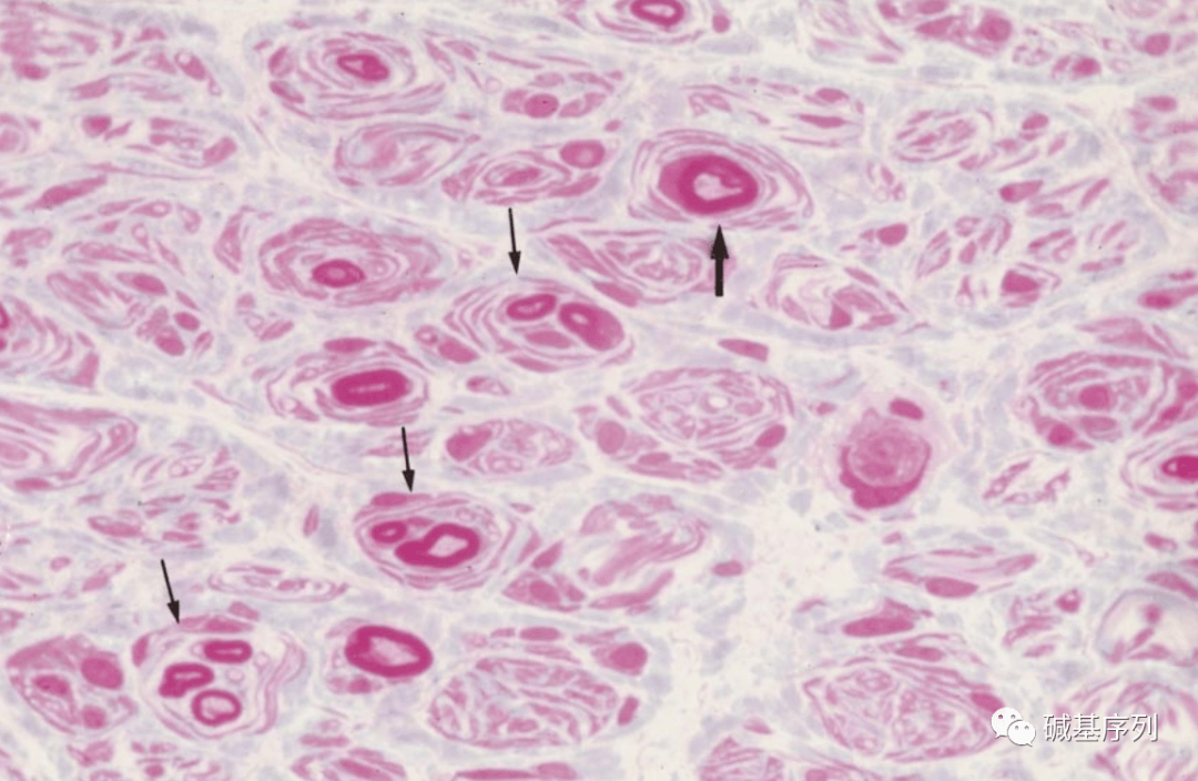 17号染色体及相关疾病(二)_基因_蛋白_遗传性