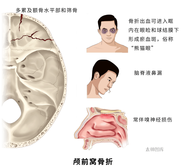 枕骨大孔骨折图片