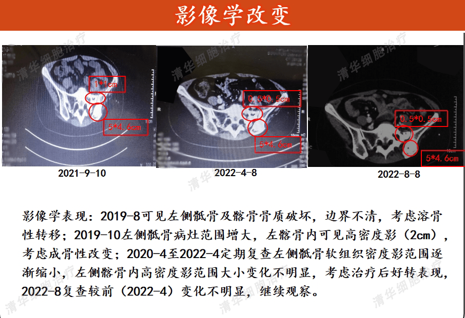 乳腺癌术后,半年骨转移,如何才能终结复发转移?_治疗_女士_患者