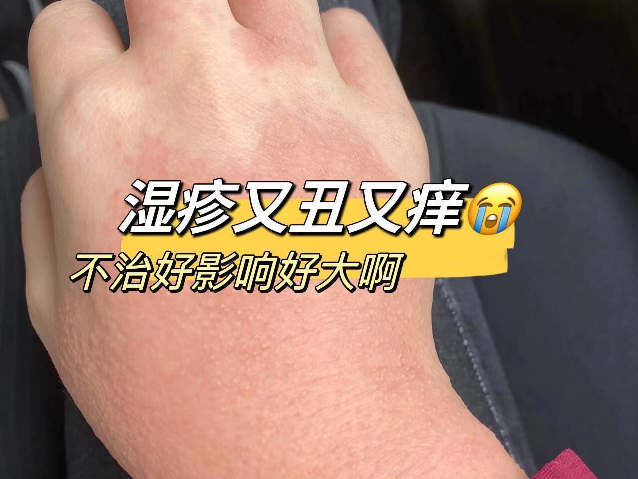 湿疹多久会自己消退图片