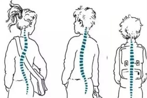 婴儿脊柱侧弯10度图片图片