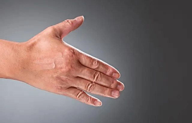 脑梗手部康复训练5个动作_手指_功能_锻炼