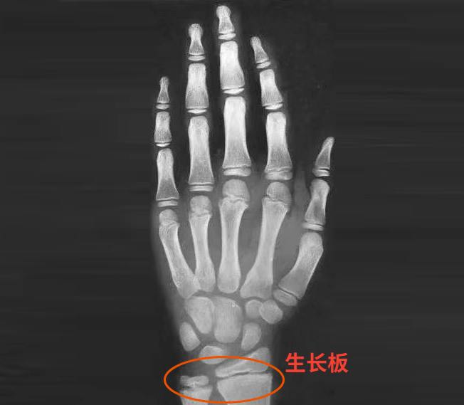 大约到了18岁左右,软骨失去增生能力,骺板(又称生长板)完全被骨组织