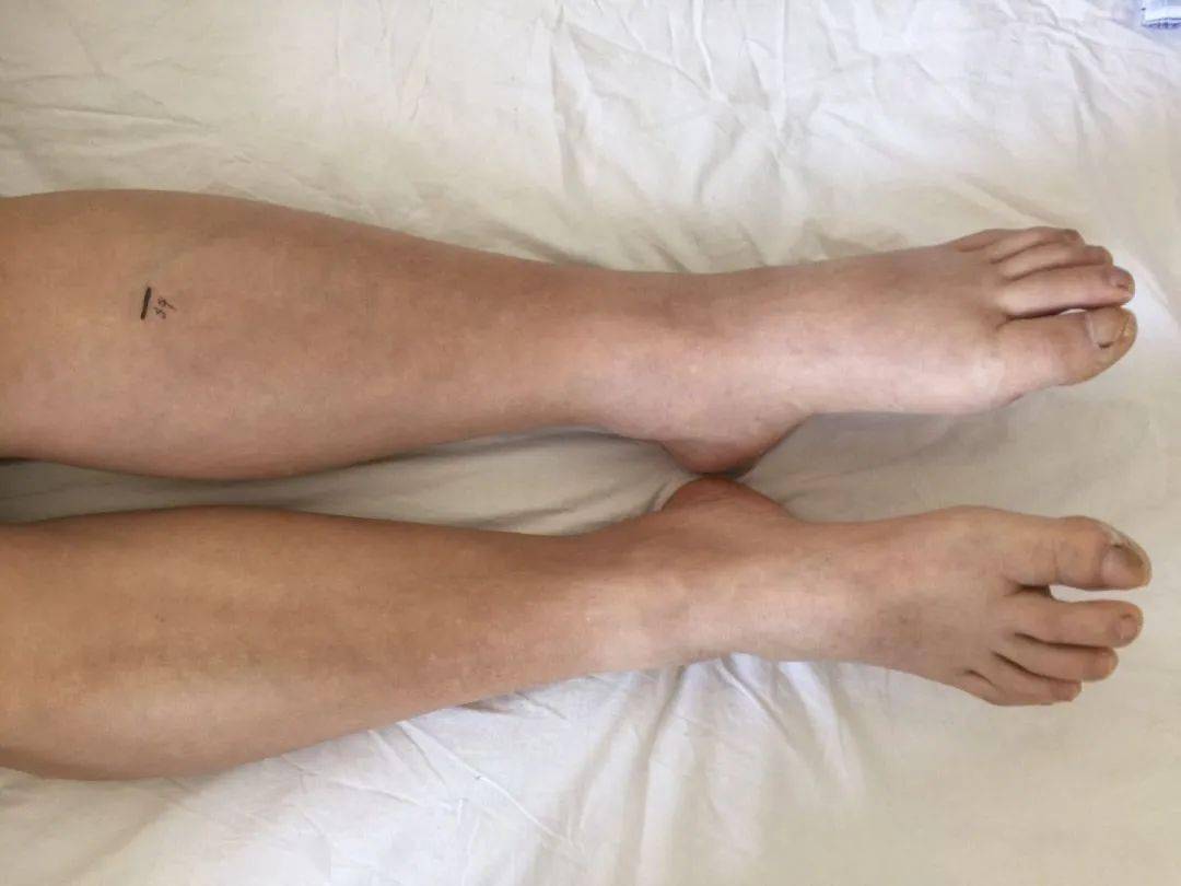 严重时会发生股青肿或股白肿