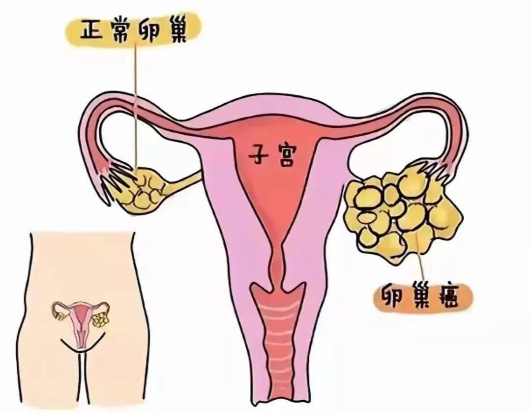 卵巢癌是女性生殖器官常见的恶性肿瘤之一,发病率仅次于宫颈癌和子宫