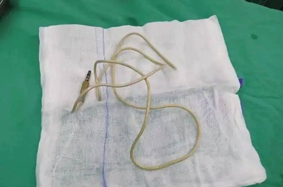 医生从少年膀胱内取出80厘米长耳机线_异物_尿道_患者