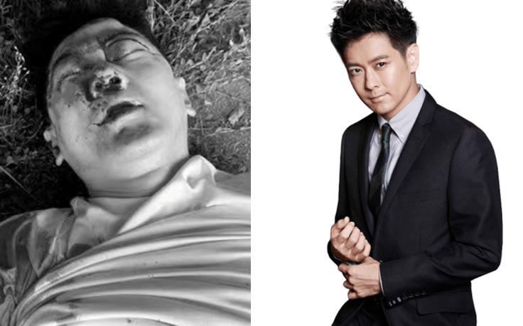 这次车祸还是较为严重的,已经涉及到骨头,他的右侧肩膀肱骨,造成了