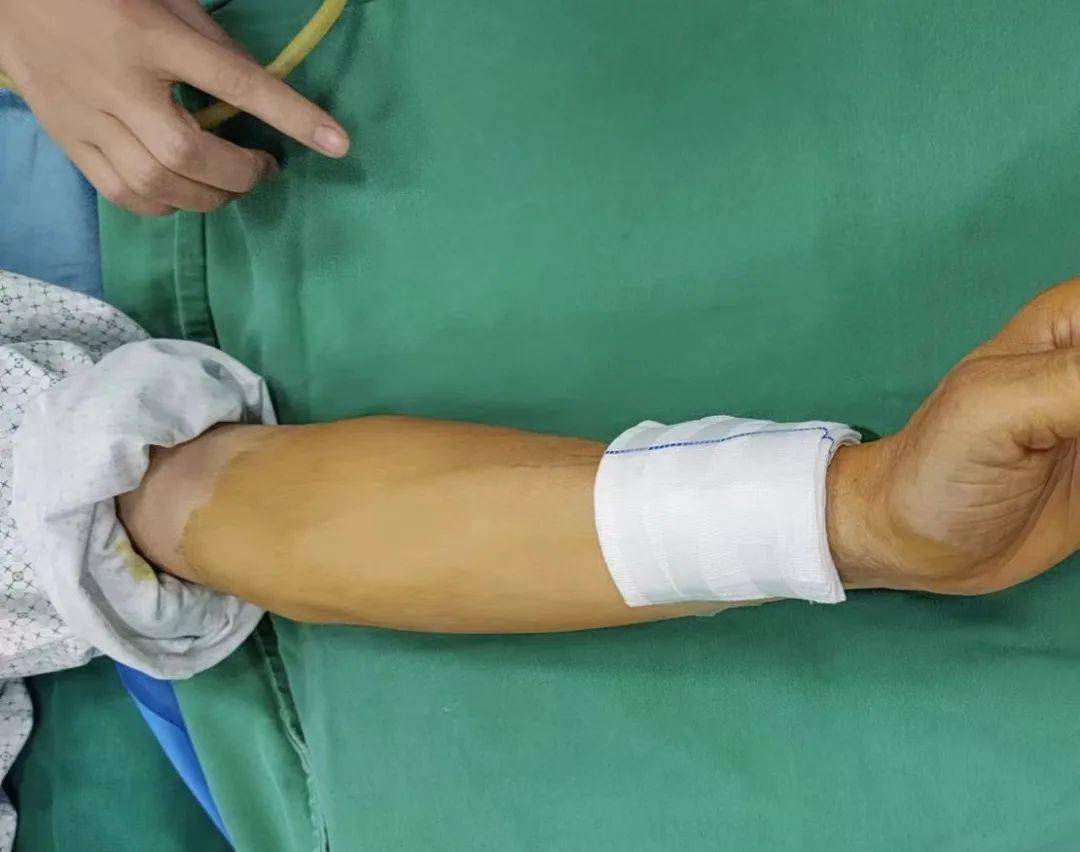 搭建"透析生命线",番禺区第二人民医院首例自体动静脉内瘘吻合术顺利