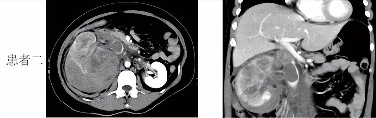 中南大学湘雅二病院胜利救治两例复杂肾癌并腔静脉癌栓患者