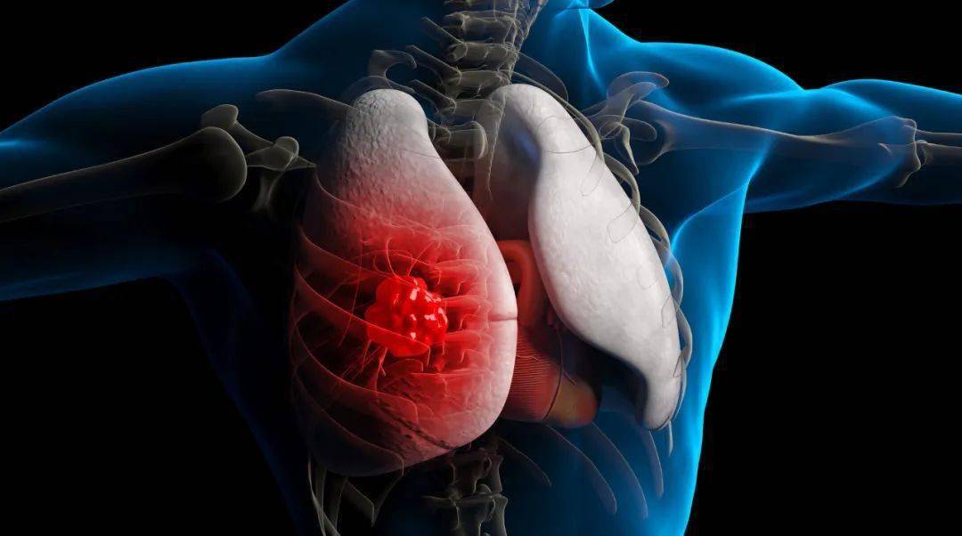 肺癌发作三年前给出的救命信号,很多女人都有,这样做可以救命!