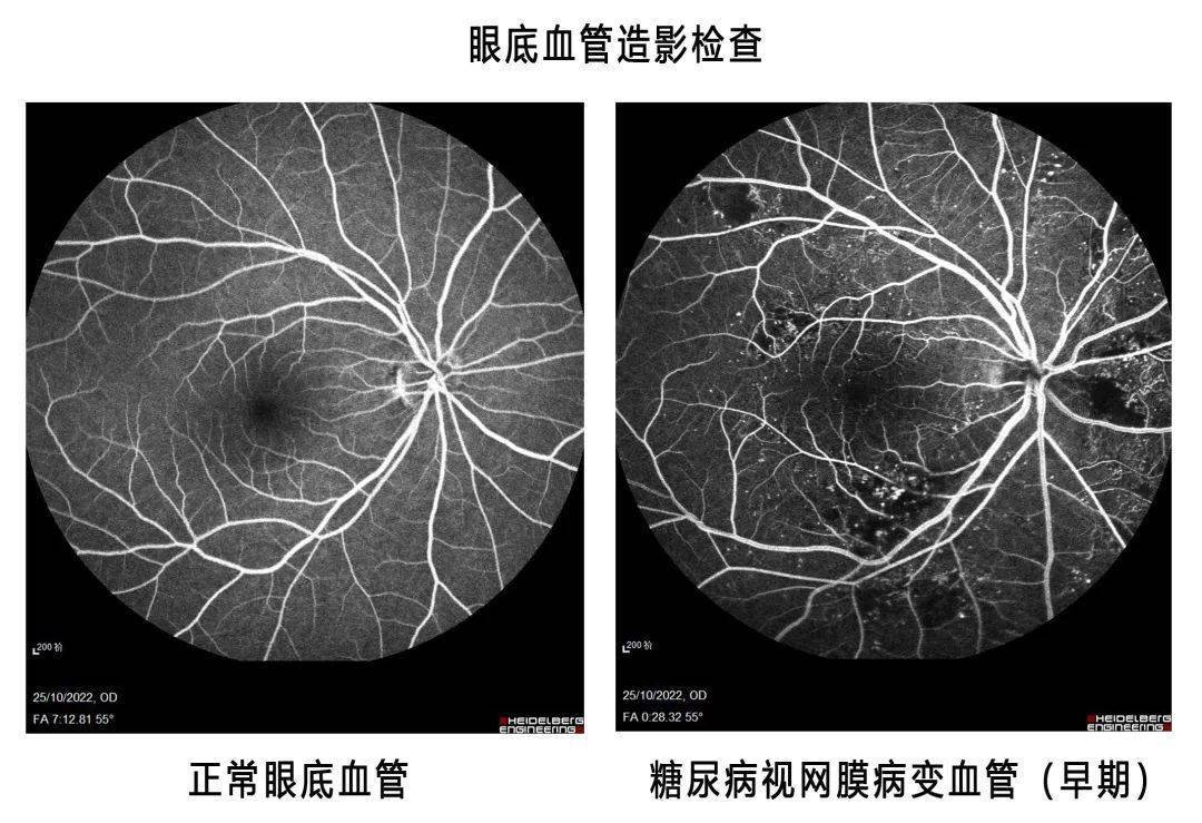 眼底出血造影图片图片